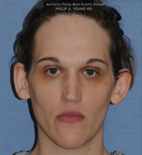 Transgender surgery before and after photos.